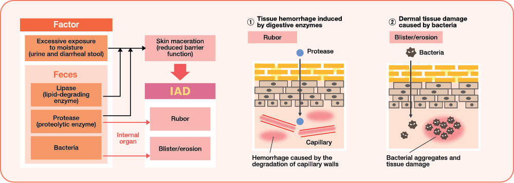 Phatogenesis of IAD