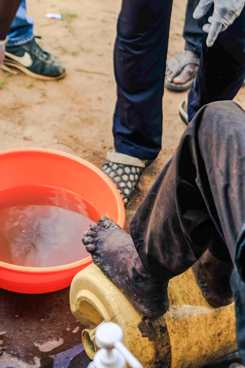 A patient's foot is washed in a basin of well water before treatment
